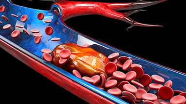 Embolia arterial