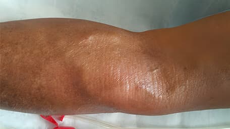 Fístulas Arteriovenosas (FAV)