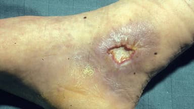 Úlceras venosas