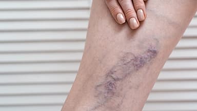 Escleroterapia