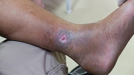 Tratamiento de úlceras venosas o arteriales