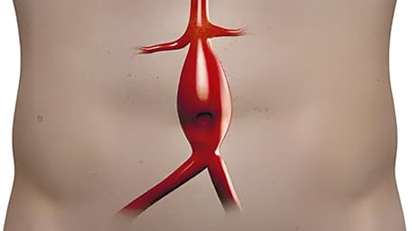 Aneurismas