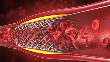 Angioplastia y colocación de stent