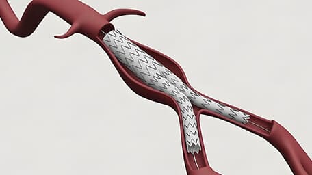 Reparación de aneurismas (abierta o endovascular)