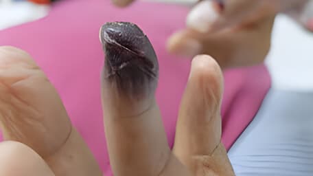 Gangrena o necrosis