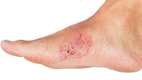 Úlceras o heridas que no cicatrizan